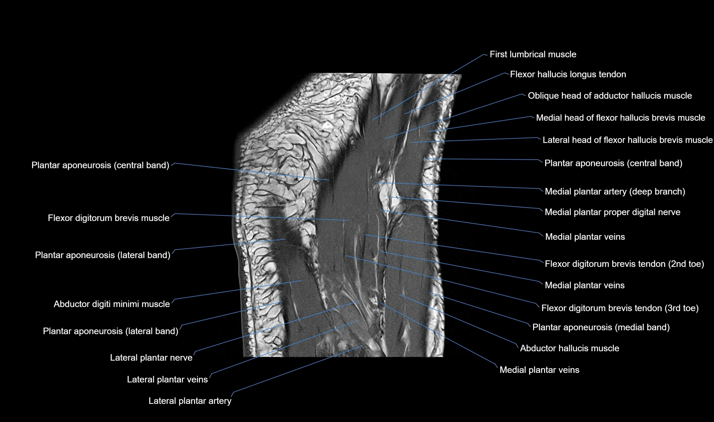 MRI mid foot coronal ligaments cross sectional anatomy 3T  radiology  image-img-00001-00035.webp